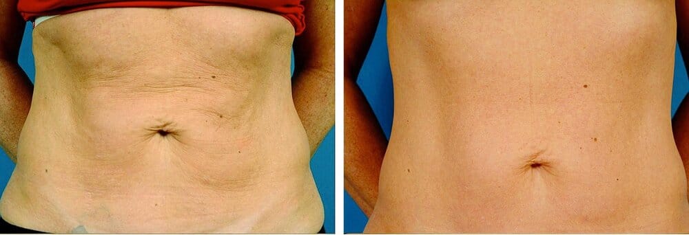 body contouring before after