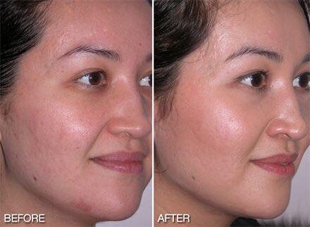 microderm before after